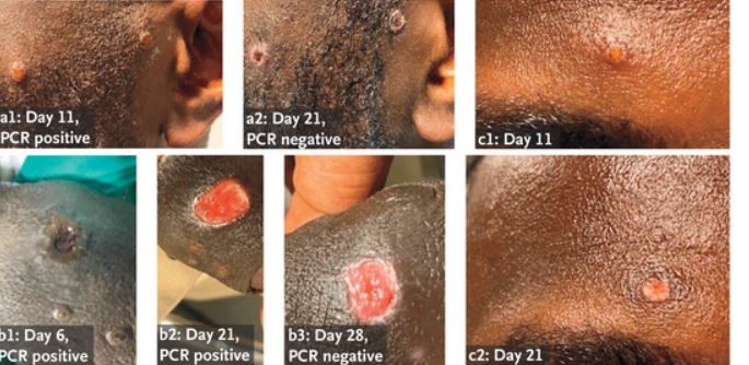 Evolução das lesões cutâneas causadas pela varíola dos macacos  (Foto: John P. Thornhill et.al )