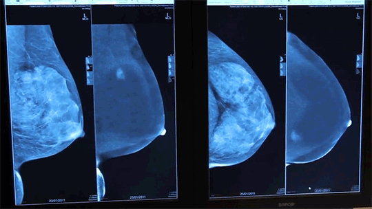 Mamografia (Foto: GE)