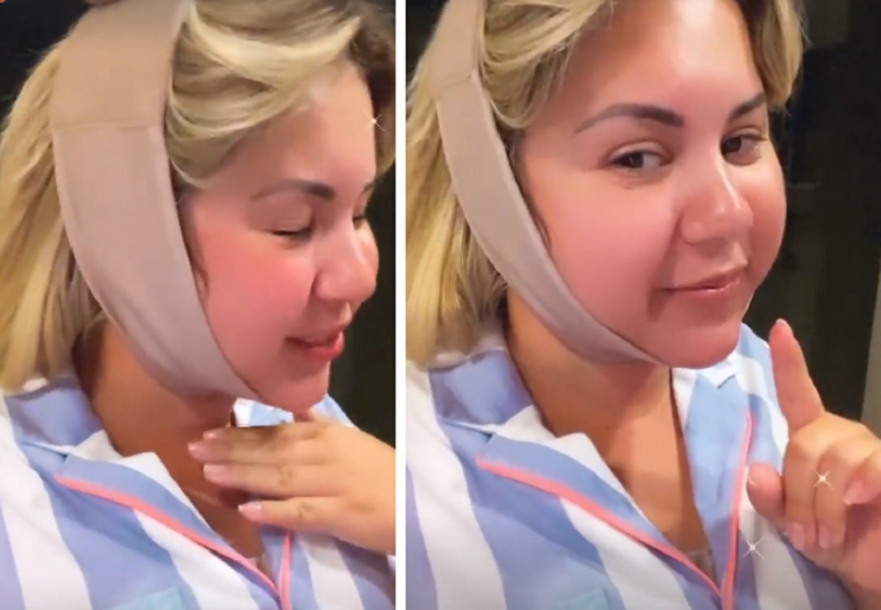 Natália Toscano usa faixa de proteção após lipo na papada (Foto: Reprodução/Instagram)