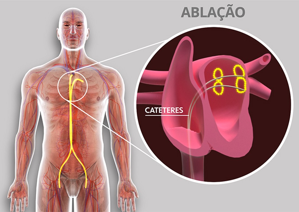 Cateteres ser&atilde;o inseridos pela virilha e v&atilde;o cauterizar tecido do cora&ccedil;&atilde;o &mdash; Foto: TV Globo