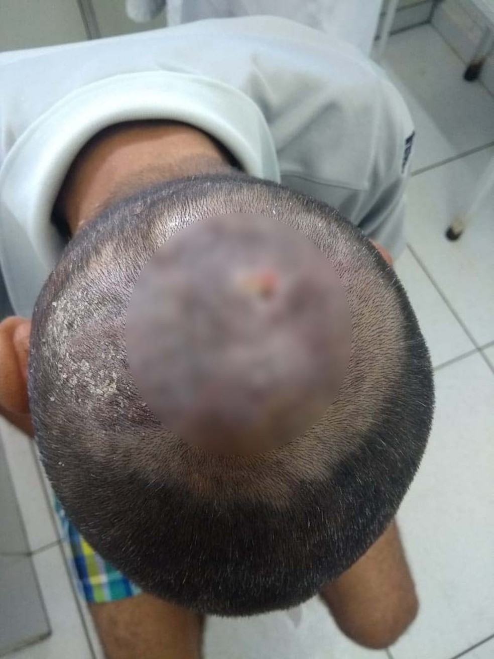 Ferimentos de pedreiro já estão cicatrizando após retirada de diversas larvas com tratamento em São Paulo — Foto: Arquivo pessoal