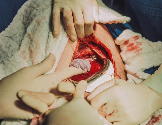 Bebê Recém-nascido Na Barriga Da Mãe Foto de Stock - Imagem de hospital,  medicina: 53657380