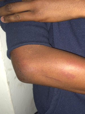 Adolescente mostra braço que diz ter sido machucado por policiais militares (Foto: Amanda Previdelli / G1)