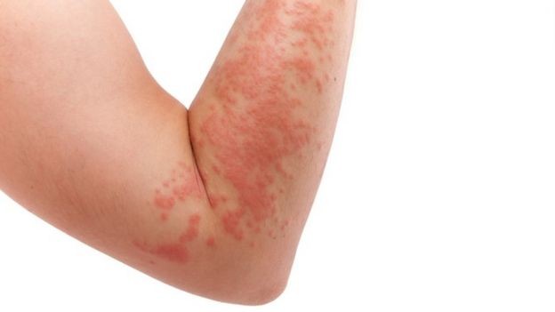 A dermatite é um tipo de inflamação que atinge a pele (Foto: Getty Images via BBC News)