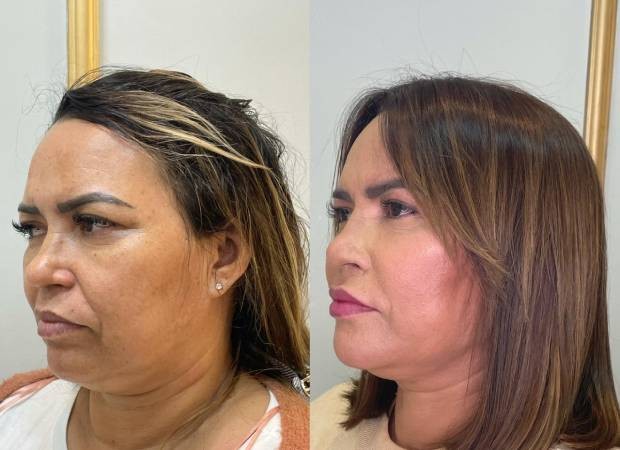 Dona Lucilene, mãe de Flay, faz harmonização facial: antes e depois (Foto: Divulgação)