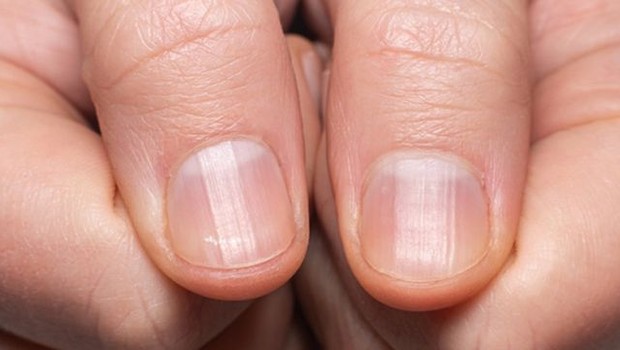 Unhas com micoses recorrentes (Foto: Getty Images via BBC News Brasil)