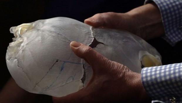Modelos 3D dos crânios de Safa e Marwa foram criados para ajudar na preparação das cirurgias (Foto: BBC )