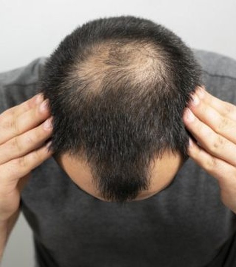 3 mitos sobre a calvície e por que ela não é 'necessariamente ruim', segundo especialista