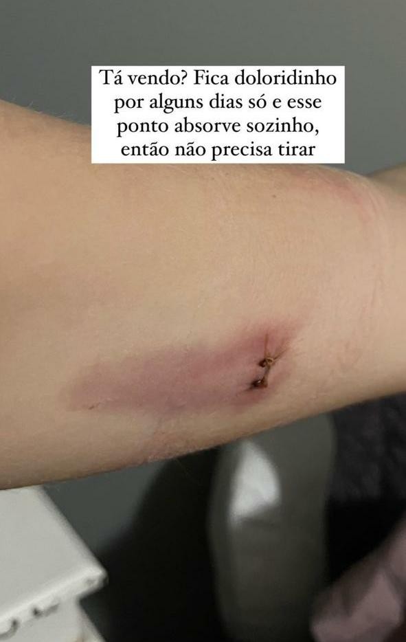 Duda Reis mostra cicatriz (Foto: Instagram)