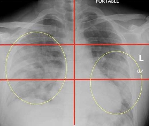 Radiografia de um homem de 30 anos cuja pontuação era de 5 (Foto: Mount Sinai Health System)