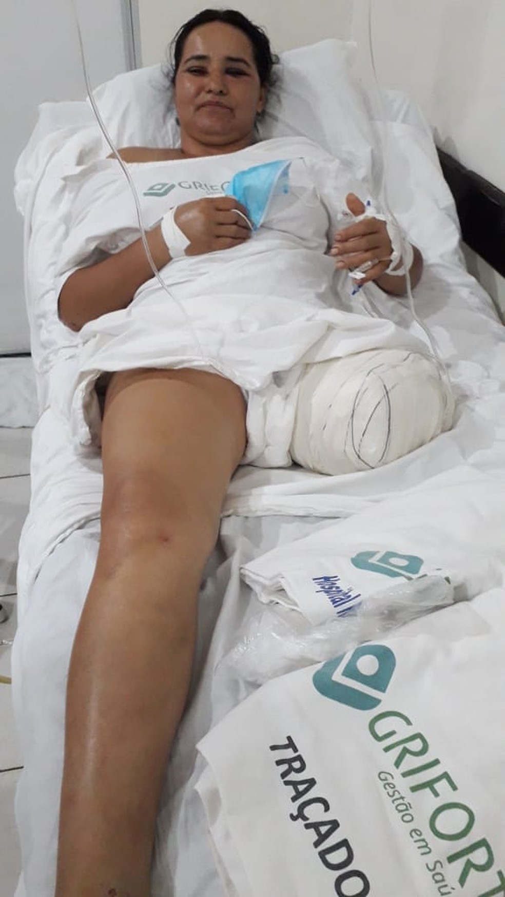  Edna Souza Ianzoni teve a perna amputada após acidente — Foto: Arquivo pessoal