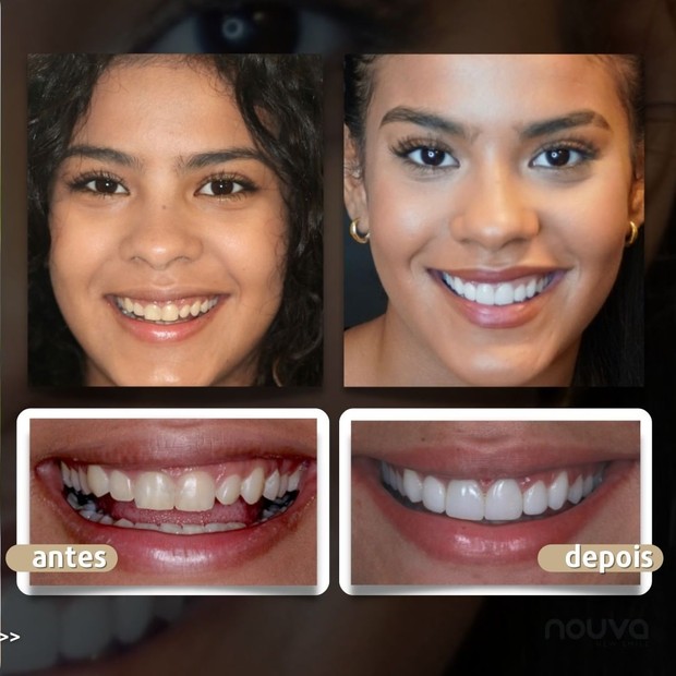 Antes e depois de Bella Campos (Foto: Reprodução/Instagram)