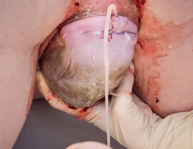 Bebê expelindo líquido amniótico por uma das narinas (Foto: Victoria Berekmeri )