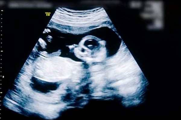 O exame de ultrassom mostrando a filha de Kylie Jenner ainda na barriga da mãe (Foto: Reprodução)