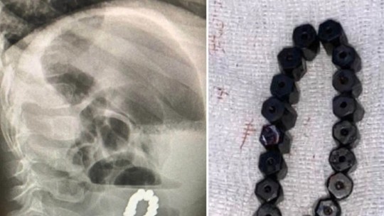 Médicos descobrem que menino que estava com dores abdominais tinha engolido pulseira 