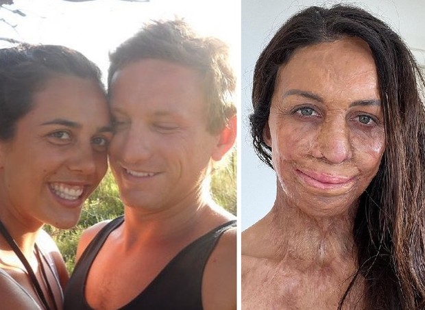 Turia antes e depois do incêndio que queimou 65% do seu corpo (Foto: Reprodução/Instagram)