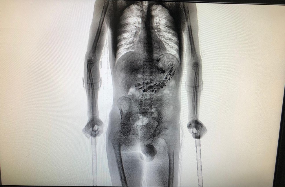 Objetos foram encontrados quando homem passou por scanner — Foto: Secretaria de Justiça e Cidadania/Divulgação 