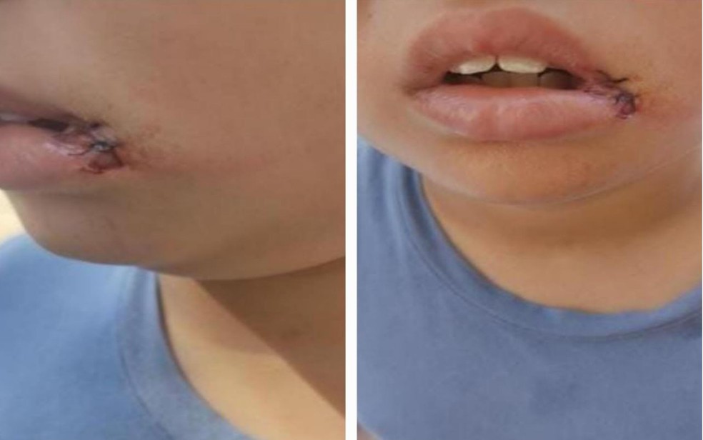 Criança teve dois dentes quebrados e a boca cortada — Foto: Divulgação/Polícia Militar