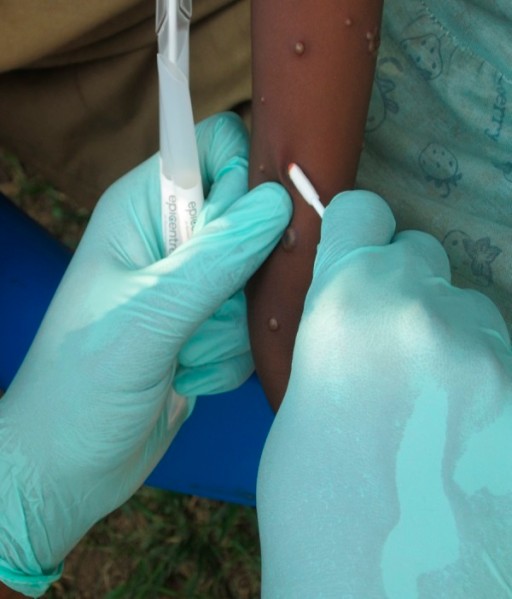 Lesões de varíola dos macacos durante uma coleta de amostra  (Foto: Wikimedia Commons )