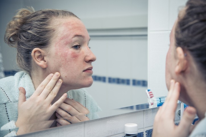 Rosácea ou acne? (Foto: Getty)