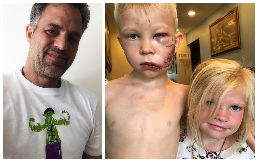 O ator Mark Ruffalo se solidarizou com o relato sobre o garotinho que precisou de 90 pontos no rosto após salvar a irmãzinha do ataque de um cachorro (Foto: Instagram)