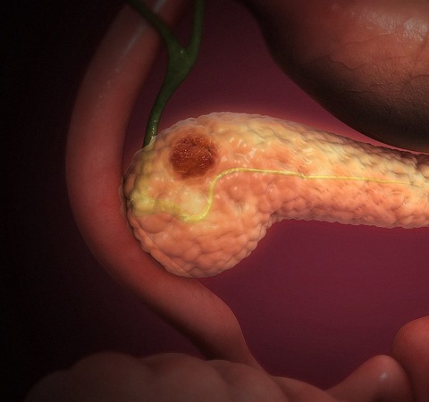 Cientistas da USP identificam genes desregulados no câncer de pâncreas