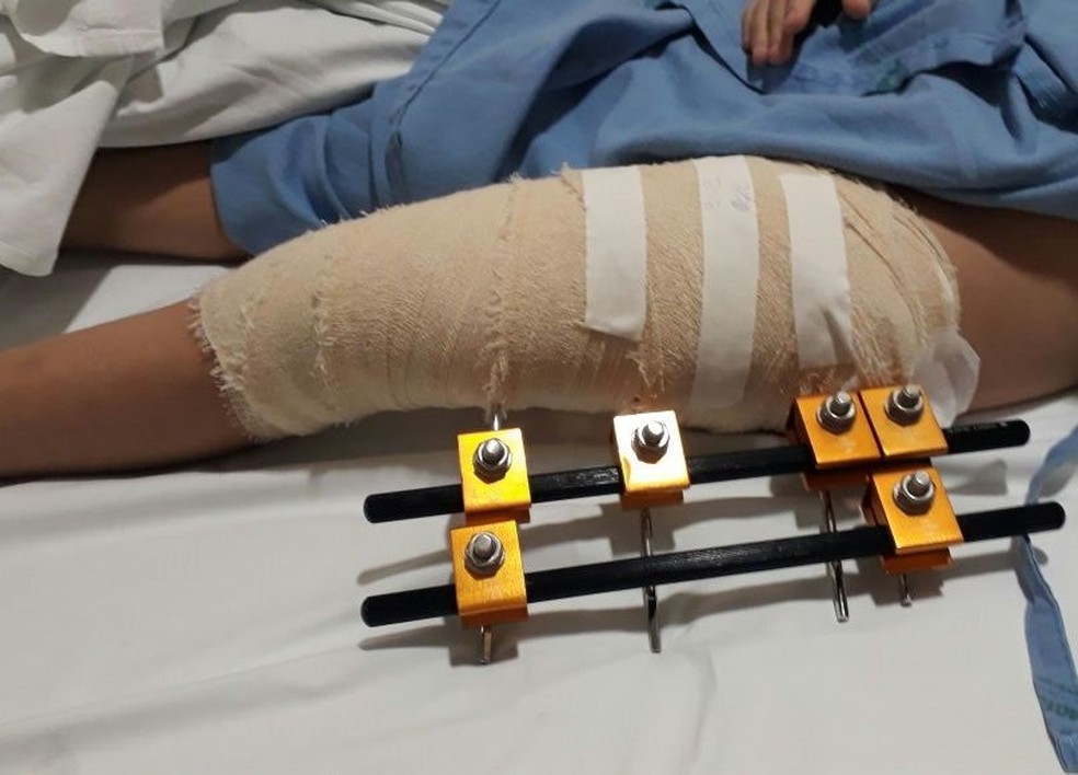 Menina De 7 Anos Fratura Femur E Passa Por Cirurgia Apos Acidente Em Desfile Na Oktoberfest Oktoberfest 2017 G1