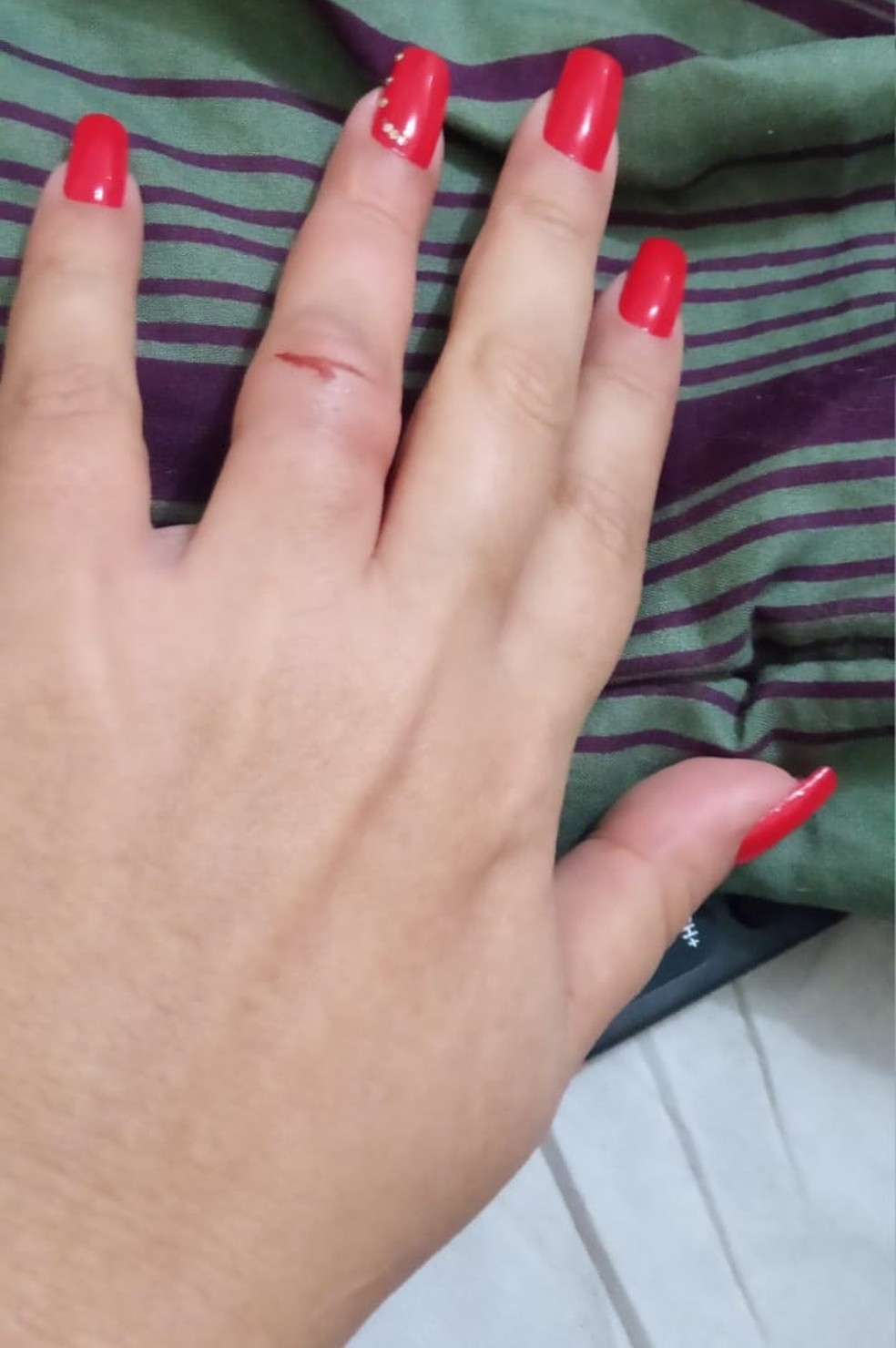 Dedo de mulher ficou machucado e inchado após assalto — Foto: Arquivo Pessoal