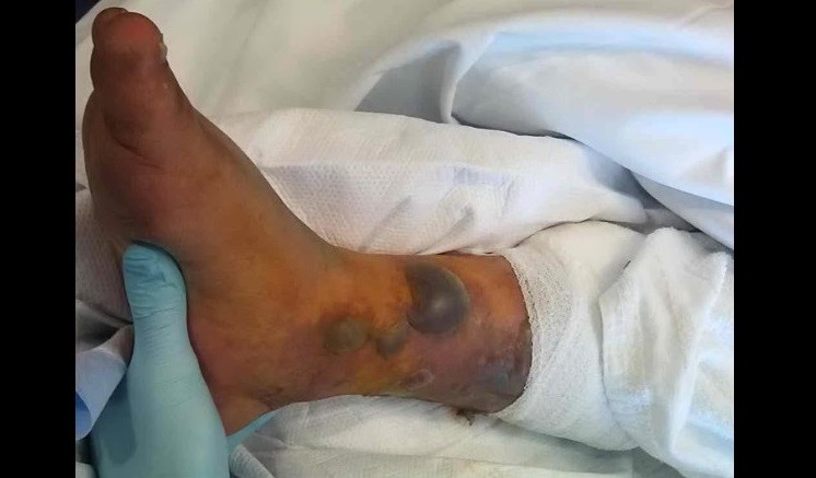 Paciente internado com infecção após tatuagem e banho de mar