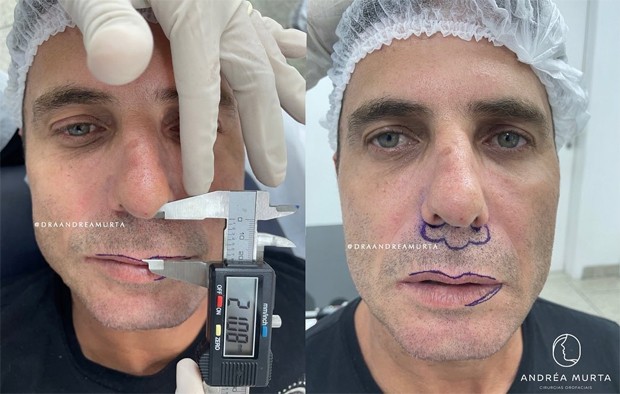 Cantor Hudson se submete a procedimento estético nos lábios (Foto: Reprodução / Instagram)