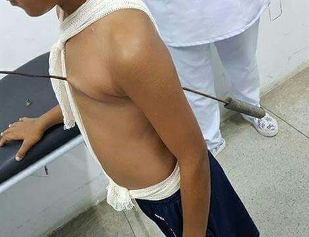 Menino de 11 anos teve o corpo perfurado com espeto de churrasco (Foto: Reprodução/Whatsapp)