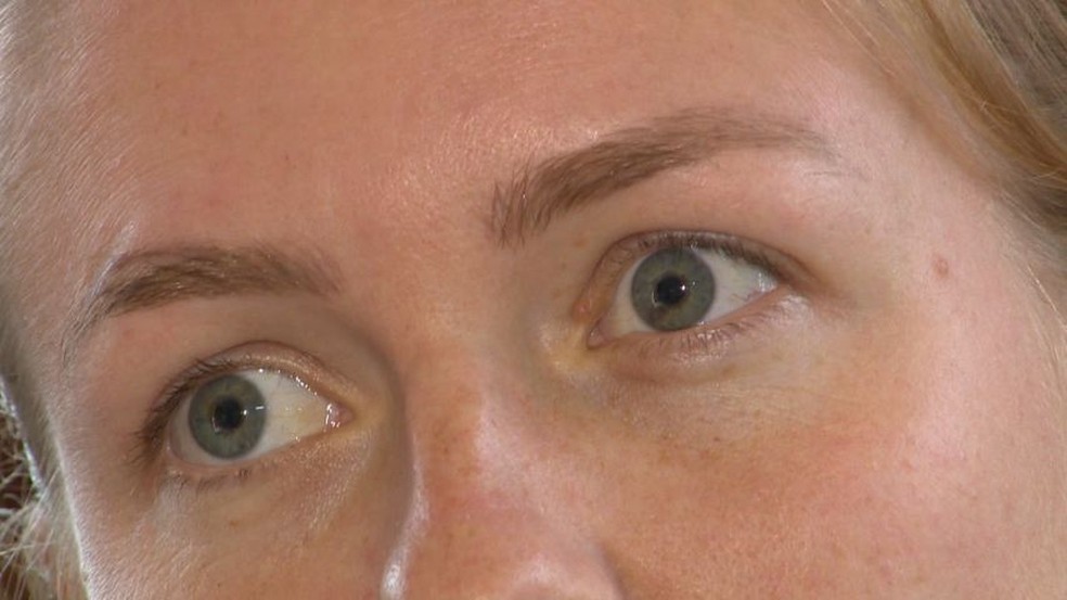 Antes da cirurgia, era possível ver o melanoma no olho de Bia — Foto: Reprodução/TV Gazeta