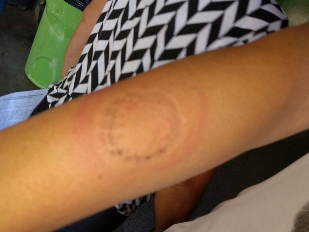 Estudante de 14 anos mordeu braço de professora, segundo polícia (Foto: Arquivo Pessoal)