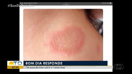 Médica tira dúvidas sobre hanseníase no Bom Dia Responde