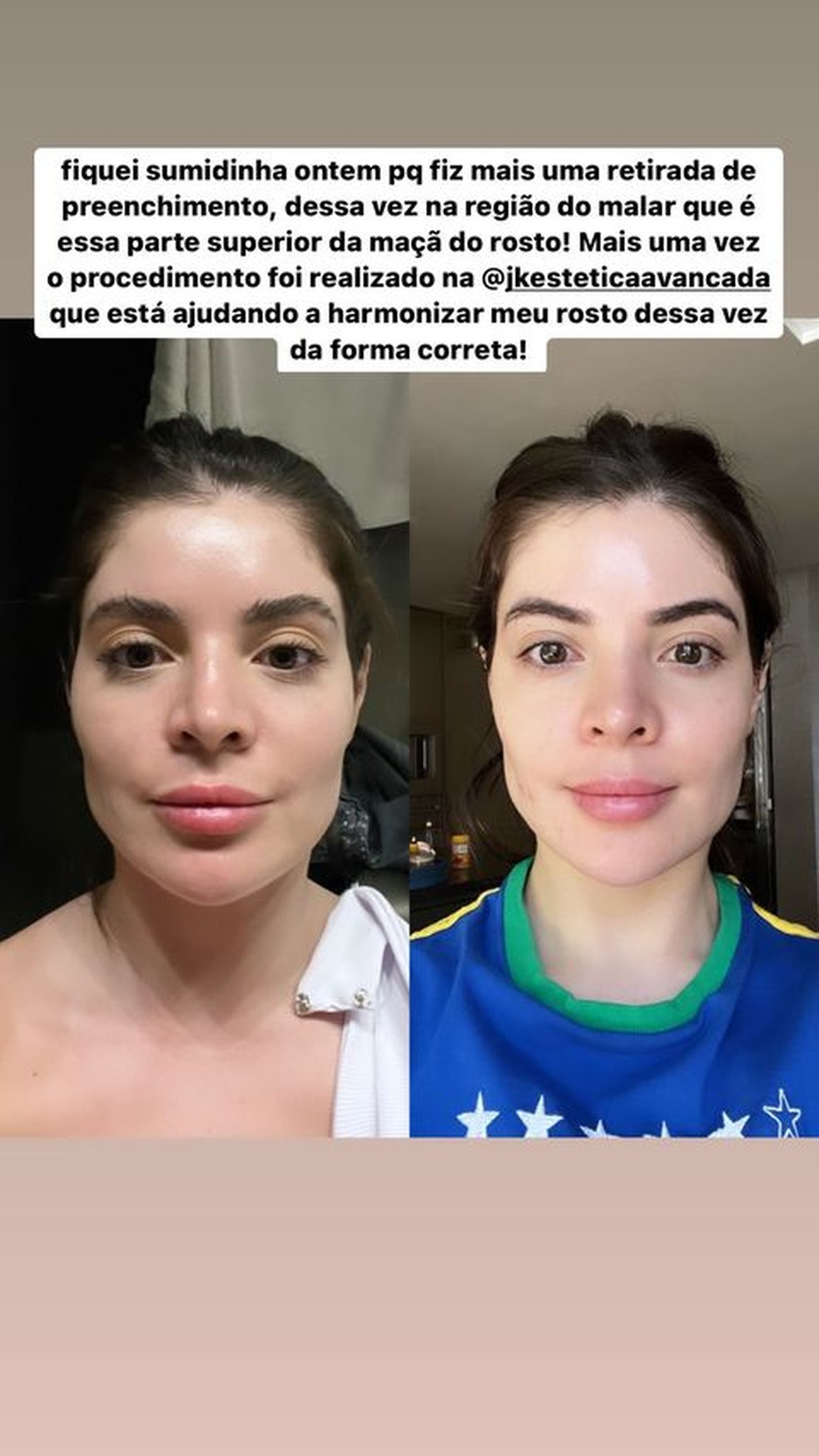 Gkay retira preenchimento no rosto &mdash; Foto: Reprodu&ccedil;&atilde;o/Instagram