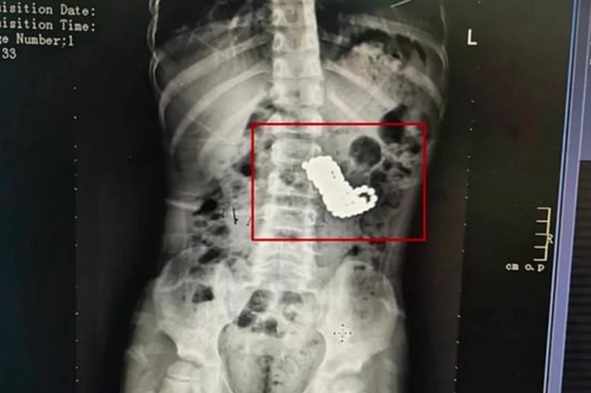 Criança passa por cirurgia para remover mais de 100 imãs do estômago (Foto: Reprodução)