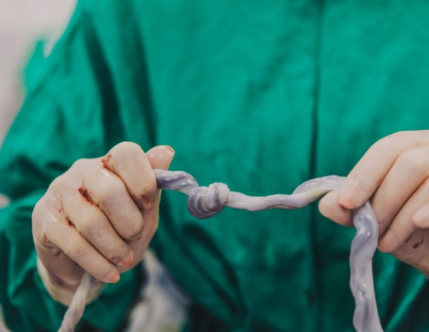 Bebê nasce com nó verdadeiro em cordão umbilical (Foto: @brunacostafotografias)