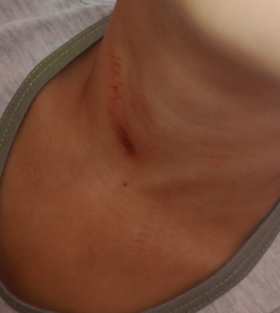Criança ficou com hematomas no pescoço após ter sido enforcada por PM aposentado  — Foto: Arquivo pessoal