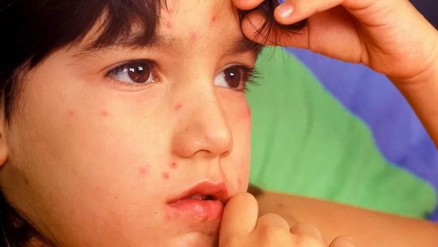 A varíola foi erradicada do mundo há 40 anos (Foto: GETTY IMAGES via BBC)