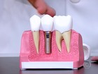 Especialistas explicam diferença entre prótese dentária e implante