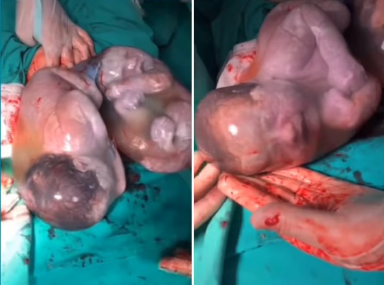 As duas meninas nasceram ainda dentro da bolsa amniótica (Foto: Reprodução/Instagram)