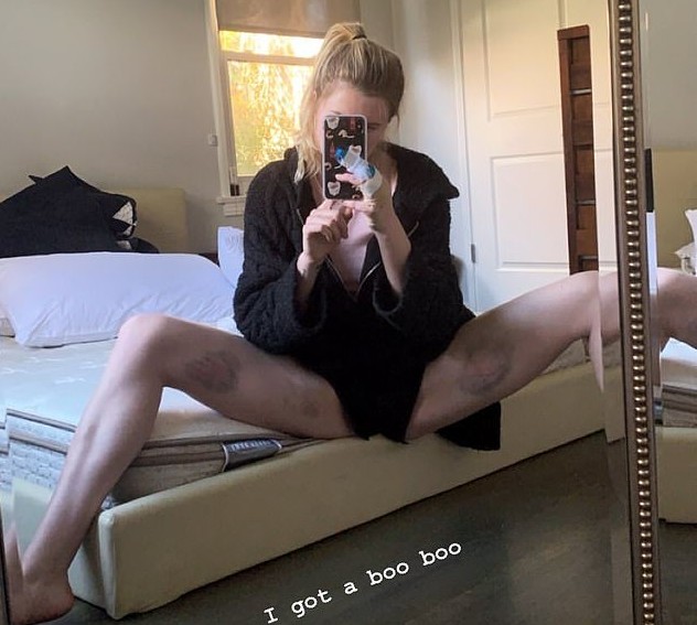 A foto compartilhada pela modelo Ireland Baldwin mostrando as lesões nas pernas dela (Foto: Instagram)