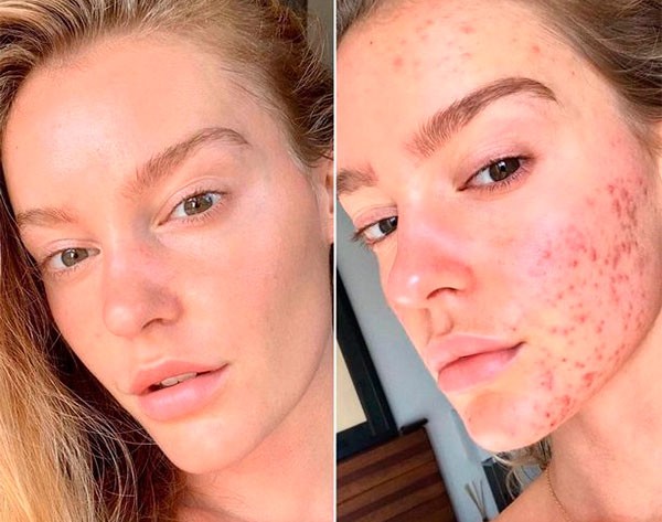 A modelo Georgia Gibbs compartilhou imagens mostrando como ficou sua pele após o tratamento contra acne severa (Foto: reprodução instagram)