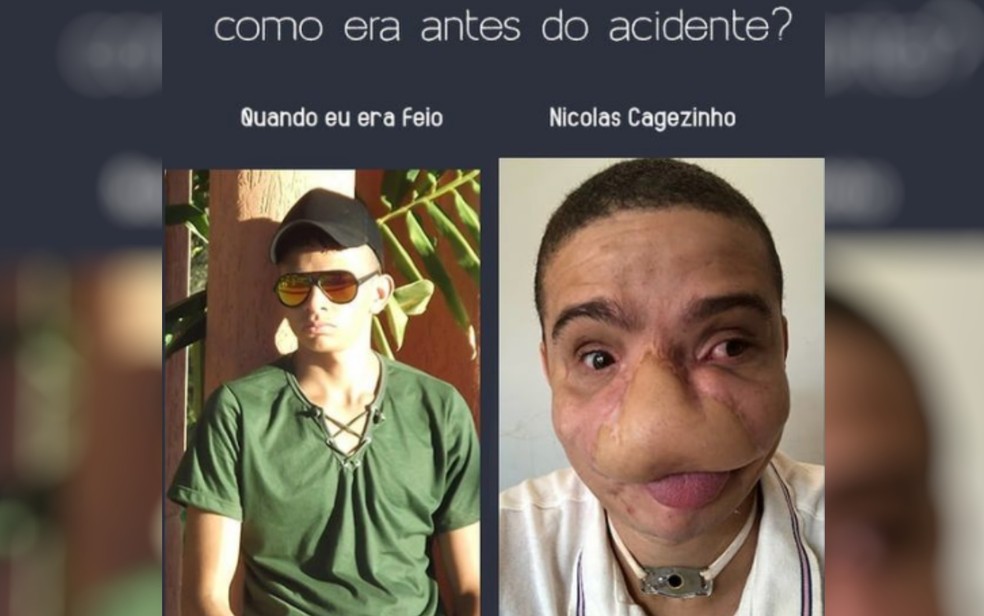 Jovem que perdeu parte do rosto ao ser atingido por fogos de artifício bomba na web ao contar sua história, em Trindade, Goiás — Foto: Reprodução/Instagram