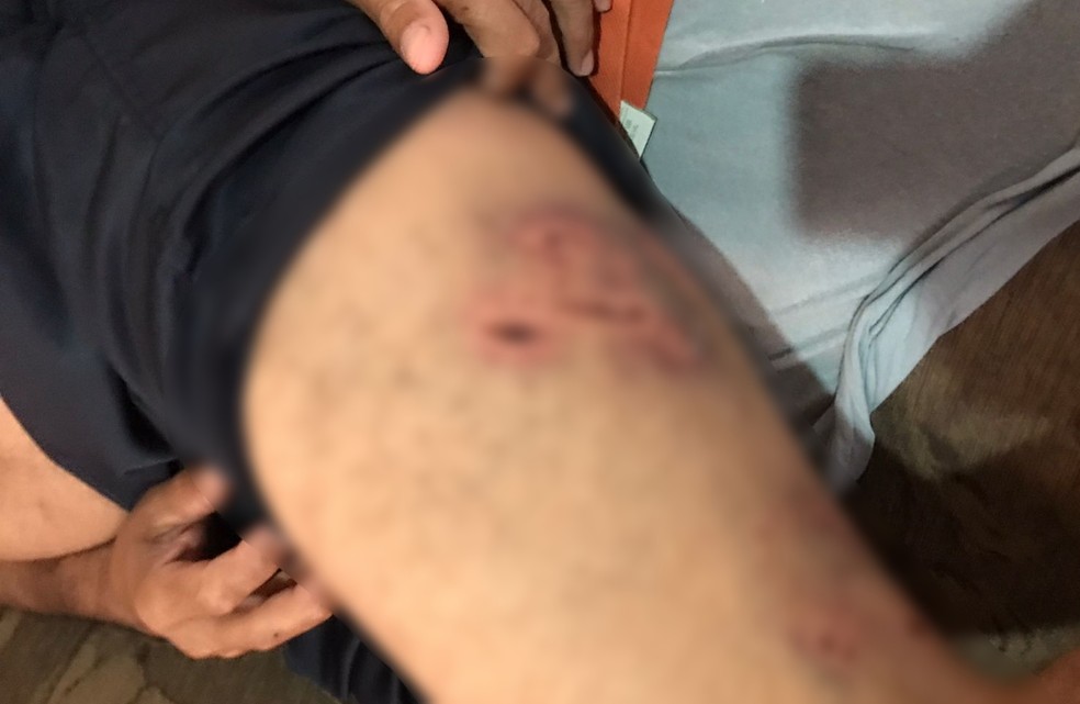 Homem de 48 anos também foi mordido por pitbull em Itaporanga (SP) — Foto: Arquivo pessoal