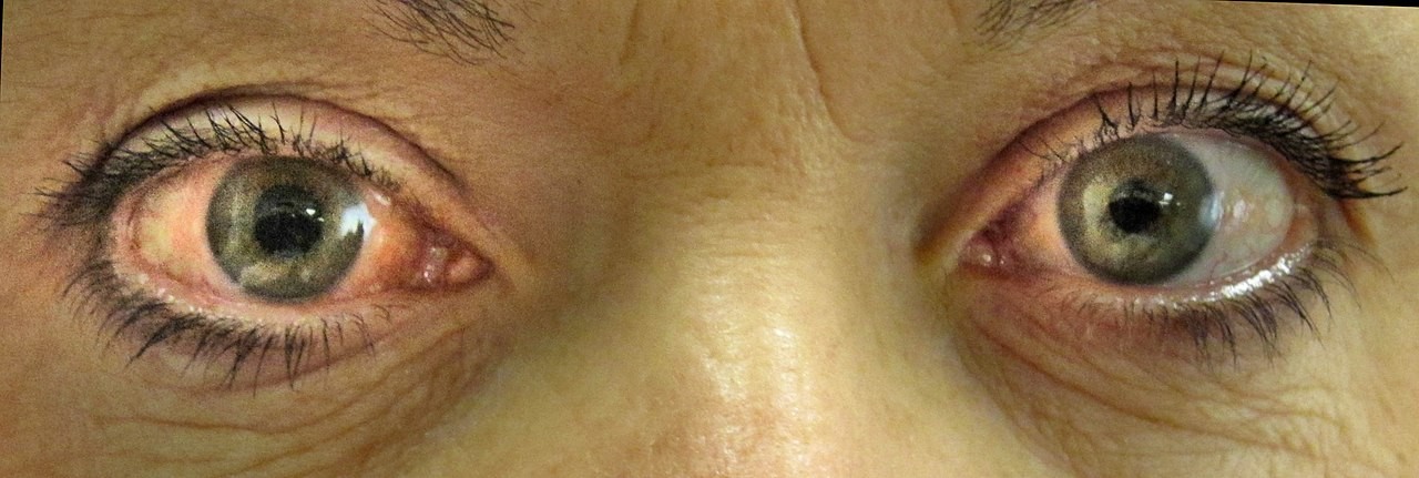Um dos sintomas do glaucoma é vermelhidão nos olhos  (Foto: Wikimedia Commons )