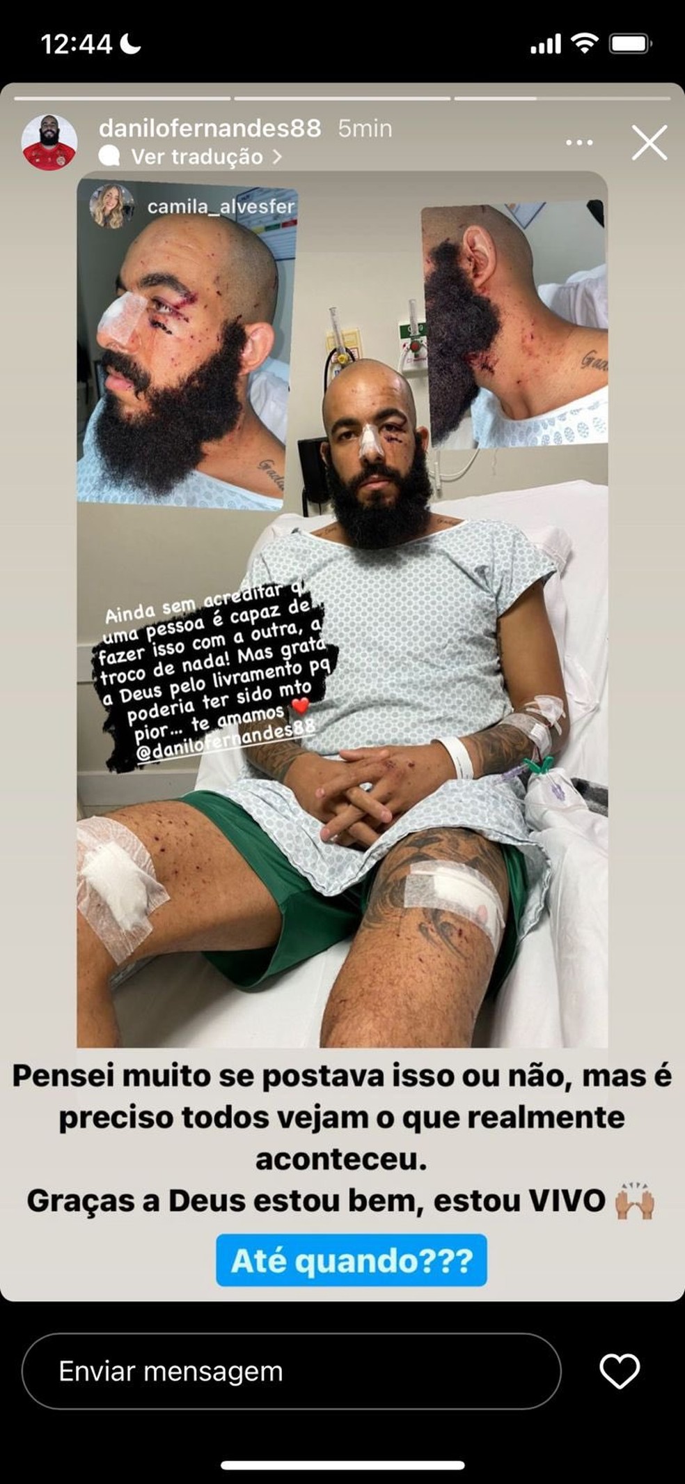 Danilo Fernandes posta foto; goleiro sofreu corte nos rosto, no braço e nas pernas — Foto: Redes sociais