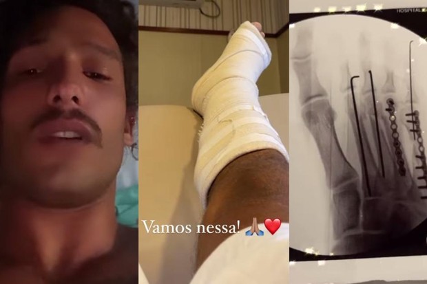 João Zoli passou por cirurgia no pé (Foto: Reprodução/ Instagram)