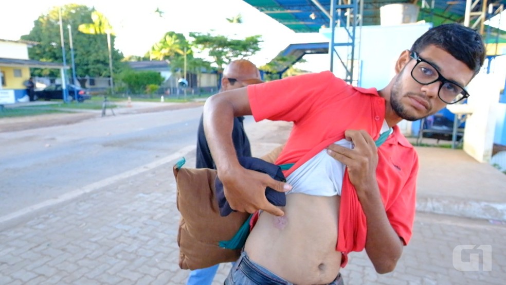 Homer Valdez, 25, mostra cicatriz de um tiro; ele afirma ter sido baleado pela Guarda Nacional Bolivariana na porta de casa (Foto: Inaê Brandão)