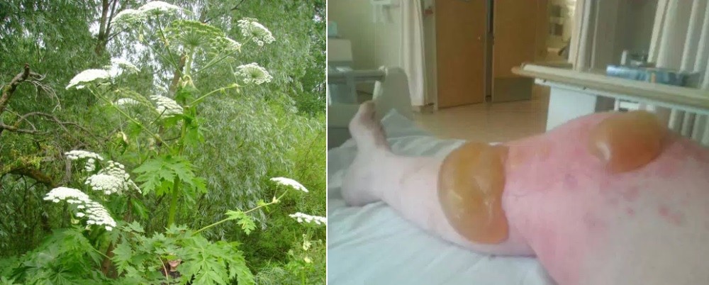 Hogweed e pessoa que sofreu queimaduras após contato com a planta